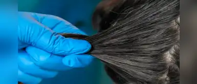 Niña muere a causa de una severa infección de piojos Niña muere a causa de una severa infección de piojos