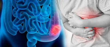 Cáncer de colon: ¿Por qué se produce y cómo alimentarse para prevenirlo? Cáncer de colon: ¿Por qué se produce y cómo alimentarse para prevenirlo?