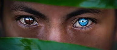 Síndrome de Waardenburg, una mutación genética que crea ojos azules Síndrome de Waardenburg, una mutación genética que crea ojos azules