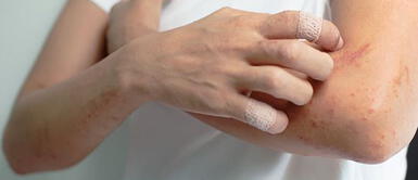 ¿Qué es la urticaria inducida por el ejercicio? ¿Qué es la urticaria inducida por el ejercicio?