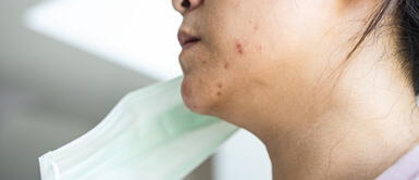 ¿Cómo evitar el acné por el uso de la mascarilla? ¿Cómo evitar el acné por el uso de la mascarilla?