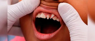 Advierten que una mala salud bucal empeora algunas enfermedades crónicas Advierten que una mala salud bucal empeora algunas enfermedades crónicas