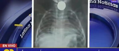 Bebé espera por más de 12 horas que le extraigan moneda de la garganta Bebé espera por más de 12 horas que le extraigan moneda de la garganta