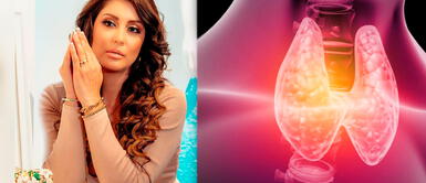 ¿Qué es el hipotiroidismo? La afección que sufre Karla Tarazona ¿Qué es el hipotiroidismo? La afección que sufre Karla Tarazona