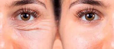 Volbella, el nuevo tratamiento que promete eliminar las bolsas en los ojos Volbella, el nuevo tratamiento que promete eliminar las bolsas en los ojos