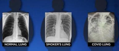 Los pulmones de un paciente con COVID-19 quedan peor que los de un fumador Los pulmones de un paciente con COVID-19 quedan peor que los de un fumador