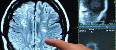 Coronavirus: descubren qué provoca la "niebla cerebral" en pacientes COVID-19 Coronavirus: descubren qué provoca la "niebla cerebral" en pacientes COVID-19