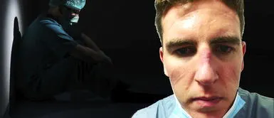 Enfermero muestra su rostro con heridas por uso permanente de mascarilla en el trabajo Enfermero muestra su rostro con heridas por uso permanente de mascarilla en el trabajo