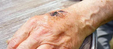 El estudio que muestra que las lesiones en la piel pueden ser un síntoma de coronavirus Estudio muestra que las lesiones en la piel pueden ser un síntoma del coronavirus