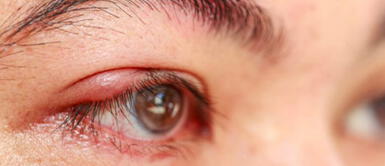 Qué es un orzuelo, cómo tratarlos y cuándo debes preocuparte por tu salud ¿Cómo tratar los orzuelos y cuándo debes preocuparte por tu salud?