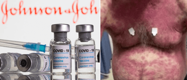 Hombre sufrió extraño efecto secundario tras recibir la vacuna de Johnson & Johnson Hombre sufrió extraño efecto secundario tras recibir la vacuna de Johnson & Johnson