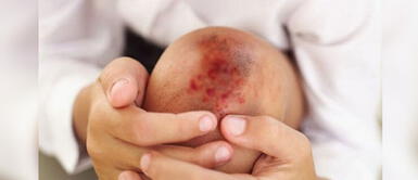 Hemofilia: Niños buscan diagnóstico en medio alerta sanitaria por COVID-19 Infantes con Hemofilia: En busca de un diagnóstico oportuno en medio de una crisis sanitaria