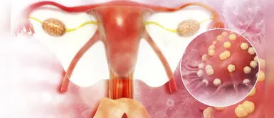 Día Mundial del Cáncer de ovario: Síntomas y tratamientos de la enfermedad Cáncer de ovario: ¿Cuáles son sus síntomas y qué tratamientos seguir?