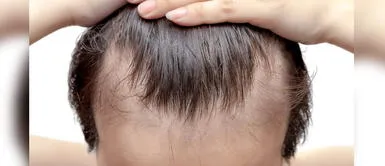 COVID-19 Estados Unidos: Hombres calvos tienen más probabilidades de sufrir síntomas graves de coronavirus Hombres calvos tienen más del doble de posibilidades de padecer COVID-19 grave