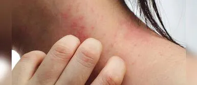 COVID-19 Perú: Doctor César Ramos asegura que se incrementaron casos de dermatitis debido al coronavirus Aumentaron problemas en la piel a causa de la COVID-19, afirma dermatólogo
