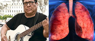 COVID-19 Perú: Hernán Condori Cachuca revela que sufre de fibrosis pulmonar tras infectarse de coronavirus ¿Qué es la fibrosis pulmonar? El mal que sufre 'Cachuca' tras superar la COVID-19