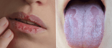 La boca seca es un síntoma que aparece hasta en la mitad de los pacientes COVID-19 Mitad de contagiados por COVID-19 presentaron como síntoma la aparición de la boca seca