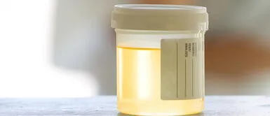 Se trata de una mujer de 61 años que tenía un diagnóstico de diabetes y cirrosis. Médicos informan el primer caso de una persona viva que orina “cerveza”.