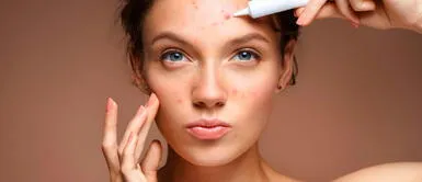 Tratamiento de acné Dermatóloga explica qué ingrediente natural es recomendable para el tratamiento del acné