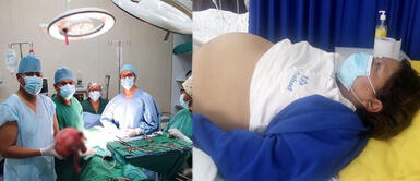 Tacna: Cirujanos extirpan tumor gigante a mujer que tenía la apariencia de estar embarazada Cirujanos extirpan con éxito tumor gigante a tacneña que tenía la apariencia de llevar un embarazo