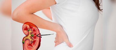 Cálculos renales: cómo eliminar las piedras de los riñones rápido con remedios caseros ¿Cómo eliminar las piedras de los riñones con remedios naturales?