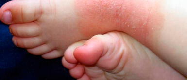 Cada 14 de setiembre se conmemora el Día Mundial de la Dermatitis Atópica. Dermatitis Atópica: ¿Cuáles síntomas y qué tanto afecta a los que la padecen?