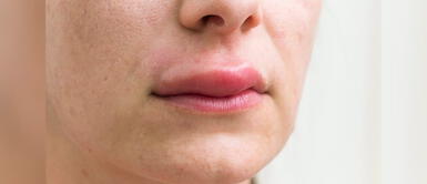 Este padecimiento podría afectar a 1 de cada 50 mil personas. Angioedema hereditario: ¿De qué se trata este mal y a cuántas personas podría estar afectando en Perú?