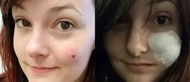 Joven descubre su cáncer a la piel por lunar Joven descubre que lunar de corazón en su rostro era cáncer de piel