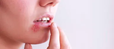 El "beso de araña" puede ser controlado con remedios caseros fáciles y rápidos. ¿Cómo curar el 'beso de araña' con remedios naturales desde casa?