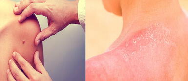 Cuidado con el cáncer de piel. Evita exponerte al sol sin bloqueador y revisa tus lunares. Liga Contra el Cáncer lanza campaña: “Octógonos Solares” para prevenir el cáncer de piel