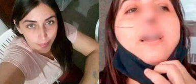 Claudia Serran rechazó los antibióticos porque es alérgica a la penicilina Argentina: mujer pierde el cartílago de su nariz por un PCR mal hecho