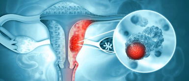 Cinco consejos para prevenir el cáncer de cuello uterino. Cáncer de cuello uterino: Cinco consejos para prevenirlo