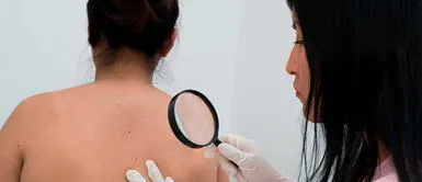 Los lunares son la acumulación de células pigmentarias Cáncer de piel: aprende a identificar señales de riesgo de la enfermedad