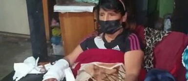 Mujer puede perder el brazo. ¡Urgente! Mujer atacada por perro pitbull necesita ser operada y teme perder el brazo