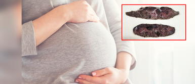 Muestras de placentas de un bebé que nació sin vida. La COVID-19 destruyó la placenta de mujeres contagiadas y mató a sus bebés