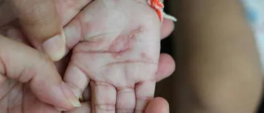 Los padres, de 29 años de edad, han sido acusados de cometer un delito de lesiones por omisión y otro contra los derechos y deberes familiares. Padres de una bebé son detenidos luego que fue hospitalizada por sarna y desnutrición