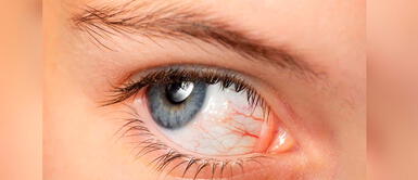 Conoce la causa de las venas rojas en los ojos. ¿Es normal tener venas rojas en los ojos? Especialista explica