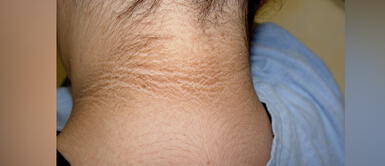 Conoce las peligrosas causas del cuello negro Cuello negro: Peligrosas razones que atentan contra tu salud