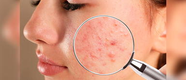 Especialistas enseñan cómo cuidar tu piel para evitar afecciones. ¿De qué forma puede el estrés afectar la salud de nuestra piel?