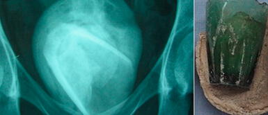 La mujer reveló que el vaso lo usó después de una práctica sexual y lo dejó en su cuerpo Túnez: mujer pensó tener infección urinaria, pero encontraron un vidrio en su vejiga