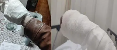 Le colocan mal el yeso tras accidente: paciente denuncia pésima atención en seguro social Le colocan mal el yeso tras accidente: paciente denuncia pésima atención en seguro social
