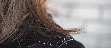 caspa ¿Cómo quitar la caspa definitivamente y por qué se produce?