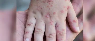 Menores infectados fueron encontrados en colegios de Ucayali. Pucallpa: Detectan más de 50 contagios probables del virus coxsackie