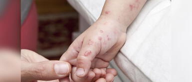 Conoce de qué trata esta enfermedad que ataca a menores de edad. Minsa emite alerta epidemiológica por brote del virus coxsackie en el país