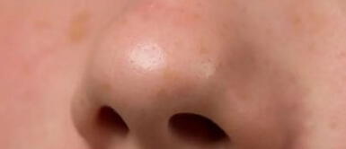 Hombre tiene una nariz que crece en su frente. Médicos chinos hacen crecer una nariz en la frente de su paciente