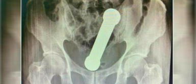 Médicos extrajeron una pesa del recto de un hombre. Hombre acude al médico por un fuerte dolor abdominal y le extrajeron una pesa del recto