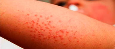 El virus pertenece a los enteovirus y las infecciones se dan en los pequeños Coxsakie: conoce más sobre el virus que está afectando a niños peruanos