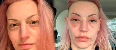 Pese a todo, Michelle Flower pide a todo el mundo vacunarse contra la COVID-19 Reino Unido: mujer se vacunó y luego 'envejeció' 20 años