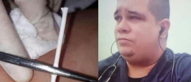Falso ginecólogo colocaba palitos de chupeta intradérmicos como método anticonceptivo Falso ginecólogo colocaba "palitos de chupete intradérmicos" como método anticonceptivo