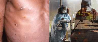 África ha mitigado brotes de viruela del mono. Viruela del mono: Cinco casos confirmados y más de 40 sospechosos en España y Portugal